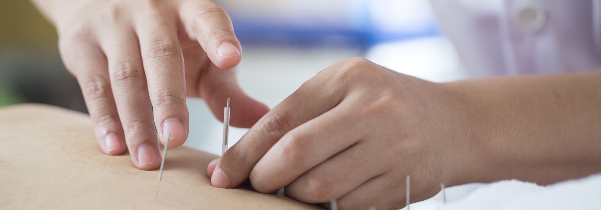 ACUPUNCTURE