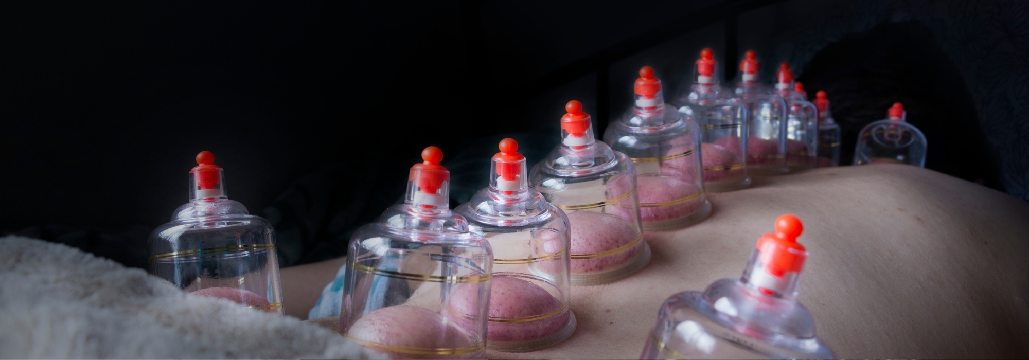 CUPPING THERAPY BANGALORE
