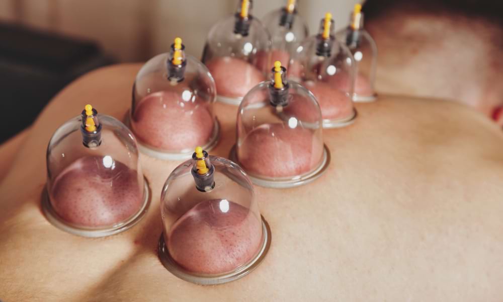 Hijama Cupping in Bangalore.