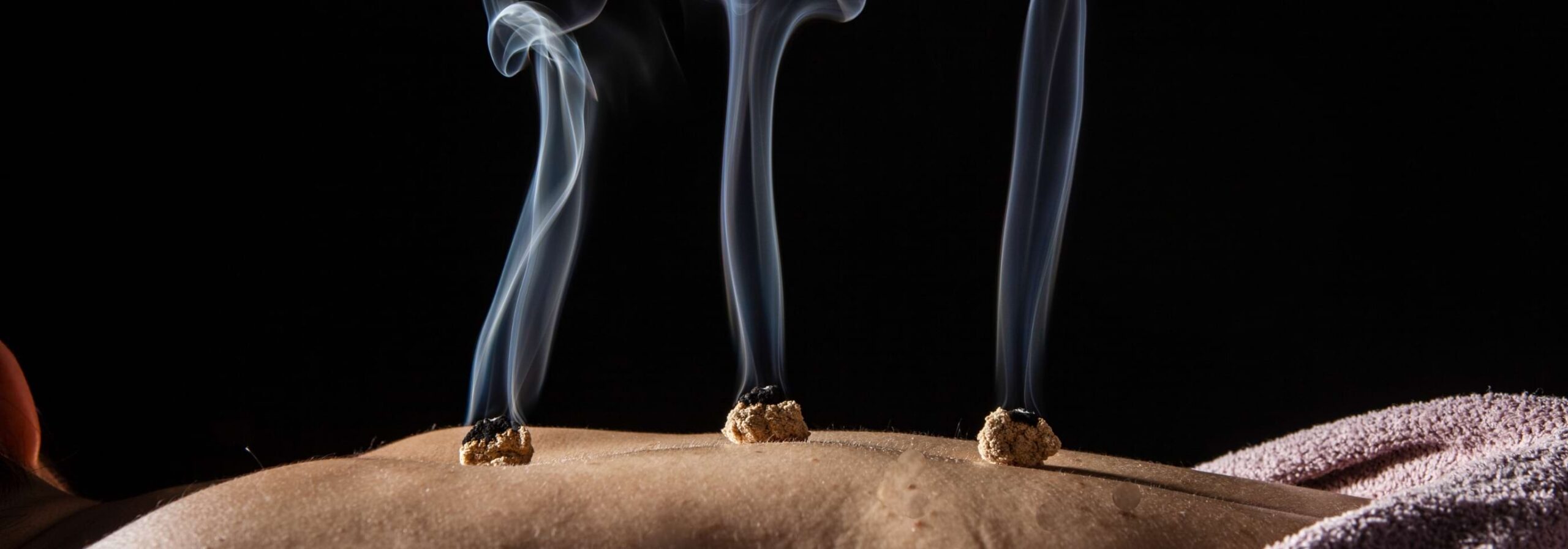 MOXIBUSTION WITH ACUPUNCTURE